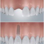 Frontzahn-Implantat mit Keramikkrone