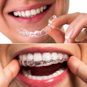 Aligner