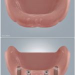 Zahnloser Unterkiefer mit 4 Implantaten