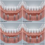 Vesorgungsmöglichkeiten des zahnlosen Unterkiefers mittels einer implantatgetragenen Prothese auf 4 Implantaten