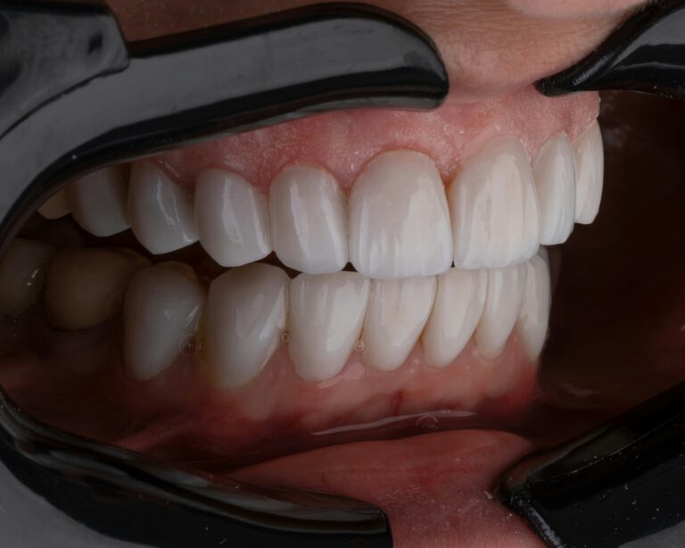 Veneer